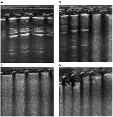 Roles of Lung Ultrasound Score in the Extubation Failure From Mechanical Ventilation Among Premature Infants With Neonatal Respiratory Distress Syndrome